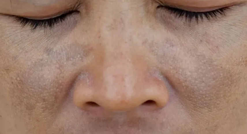 Easy Skincare Routine to Reduce Facial Pigmentation
